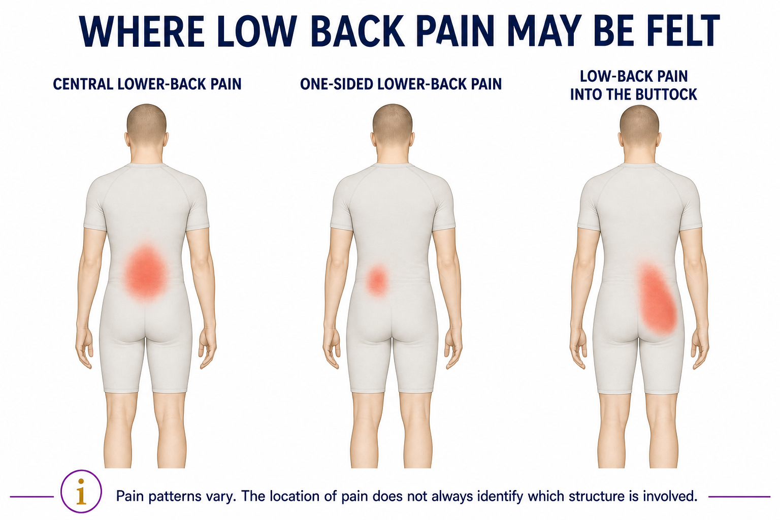 Three back-view illustrations showing central low back pain, one-sided low back pain and pain extending from the lower back into the buttock.